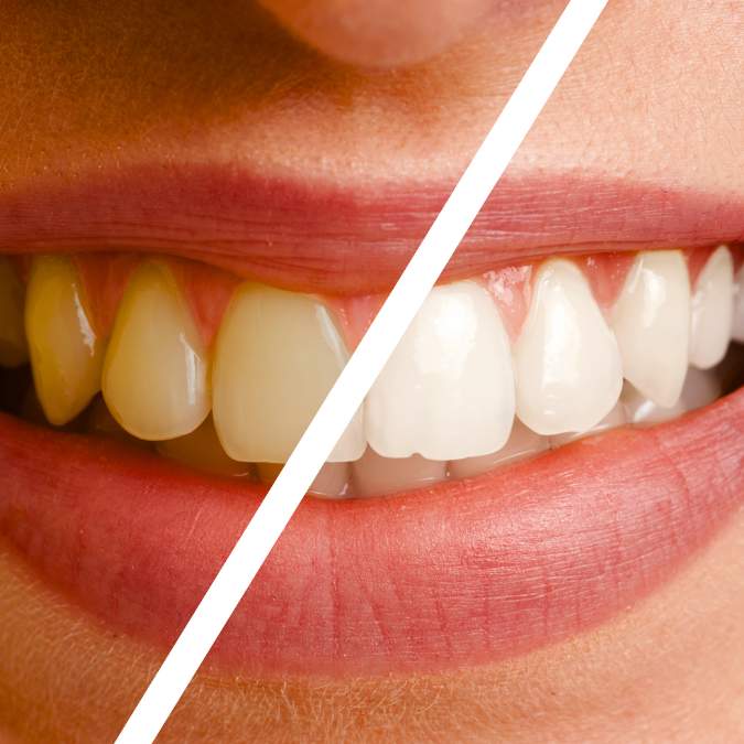 Desvendando os Mitos: Clareamento Dental Sem Segredos